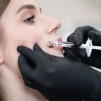 Косметолог виконує інʼєкції під час контурної пластики скул