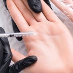 Лікування гіпергідрозу