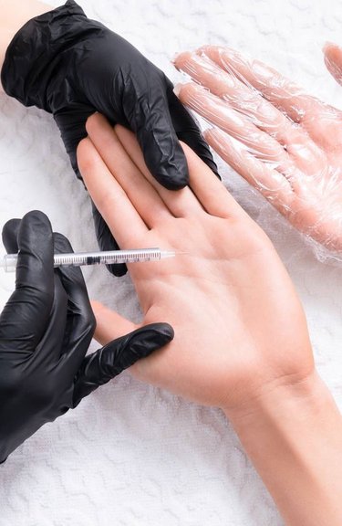 Лікування гіпергідрозу