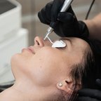 Косметолог проводить процедуру лазерного видалення судин на обличчі