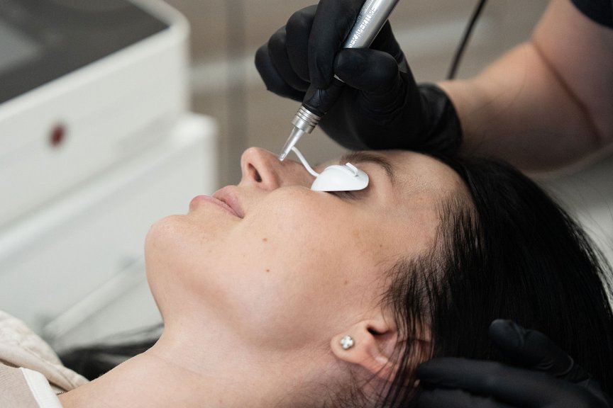 Косметолог проводить процедуру лазерного видалення судин на обличчі