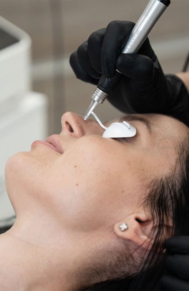 Косметолог проводить процедуру лазерного видалення судин на обличчі