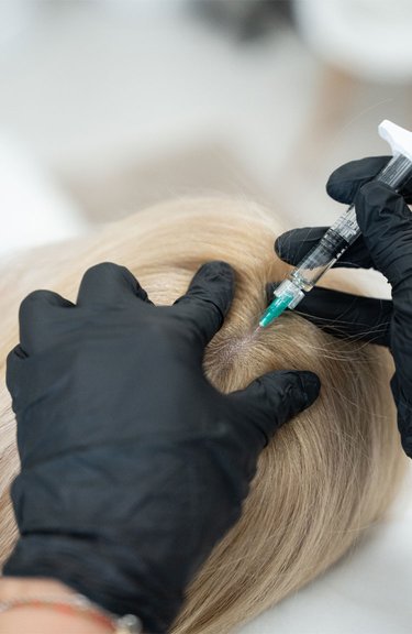 Косметолог виконує інʼєкції під час мезотерапії для лікування випадіння волосся