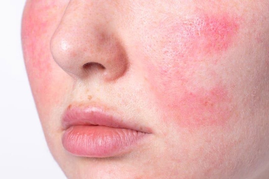 Лікування розацеа