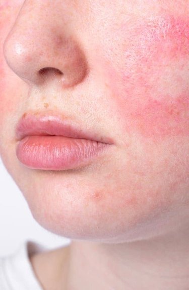 Лікування розацеа
