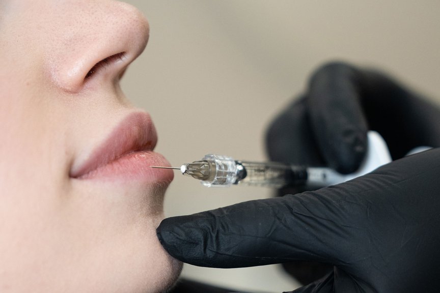 Інʼєкційна процедура для покращення форми губ