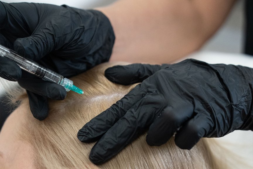 Інʼєкційна процедура для зміцнення волосяних фолікулів