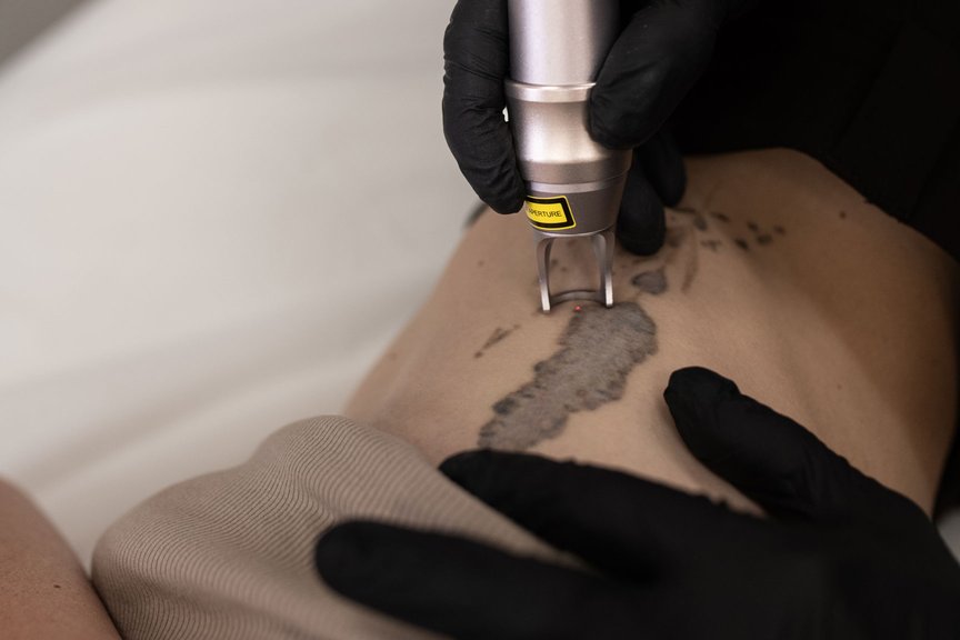 Процес видалення татуювання за допомогою сучасного лазера