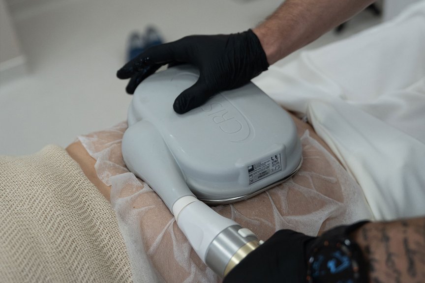 Кріоліполіз тіла — робота косметолога крупним планом