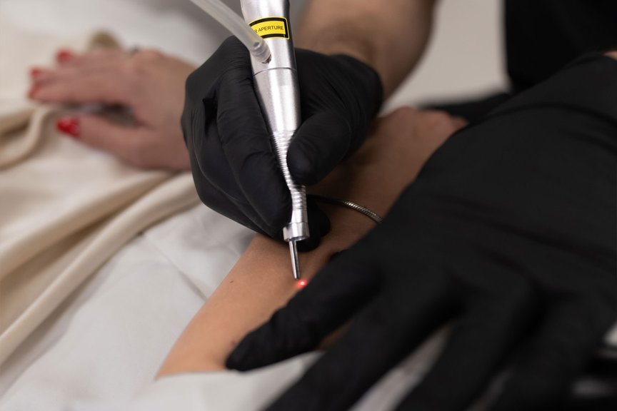 Видалення новоутворень — робота дерматолога крупним планом